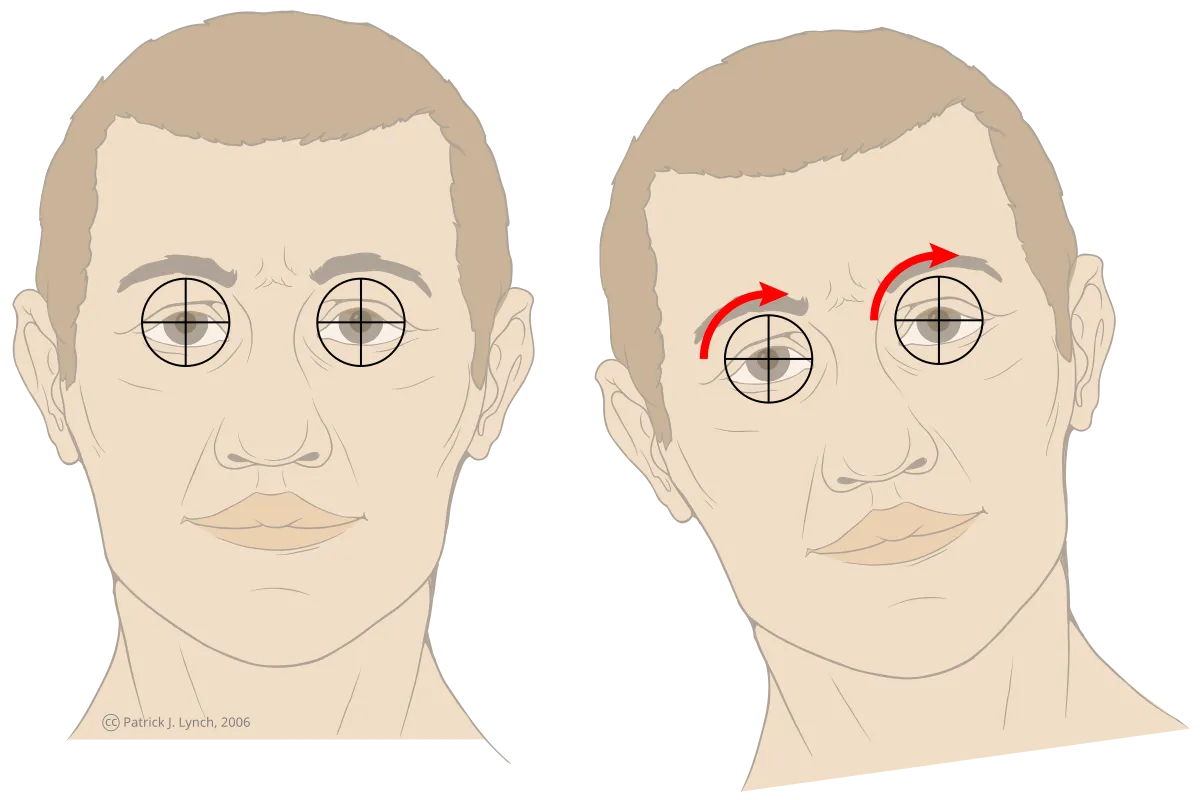 Vestibulo-ocular reflex illustration